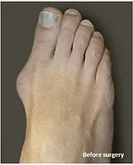 צילום כף רגל שמדגים את בליטת המפרק החוצה במקרה של אצבע קלובה/הלוקס ולגוס