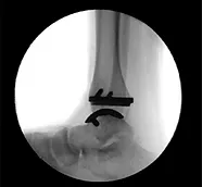 צילום רנטגן של משתל קרסול מלאכותי לאחר ניתוח החלפת מפרק קרסול