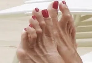 אצבע פטיש אצבע פטיש (Hammer toe) הינה עיוות של אחת או יותר מהאצבעות הקטנות של כף הרגל שגורם לכיפוף האצבע במפרק האמצעי תמונה באדיבות Arthrex International