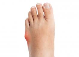ניתוח זעיר פולשני חדשני לטיפול בעצם הבולטת של האצבע הקטנה בכף הרגל.