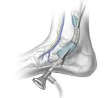 טנדוסקופיה-ניתוח זעיר פולשני חדשני לטיפול בבעיות גידים סביב כף הרגל והקרסול