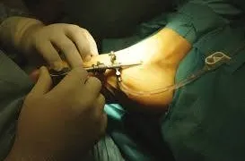 ניתוח זעיר פולשני -טנדוסקופיה