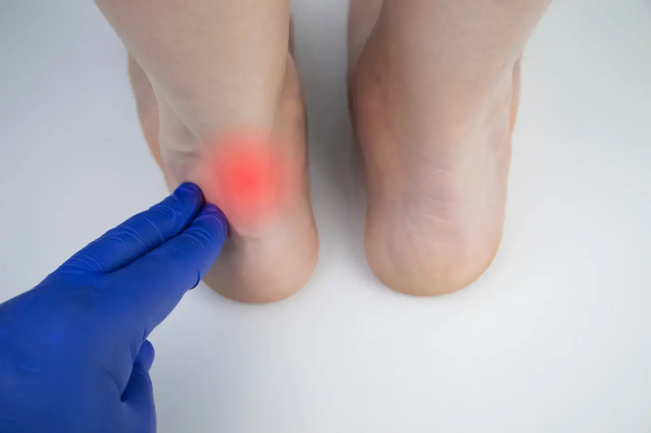 טנדינוזיס (Tendinosis): כשהכאב בגיד אינו רק דלקת
